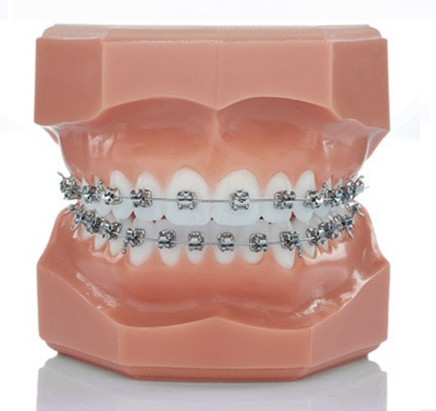 Bagues métalliques - Orthodontie Lyon Croix-Rousse