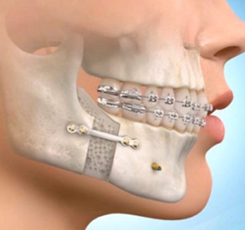 CHIRURGIE ORTHOGNATIQUE - Traitement adulte - orthodontie Lyon Croix-Rousse