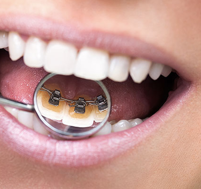 Traitement adulte - orthodontie Lyon