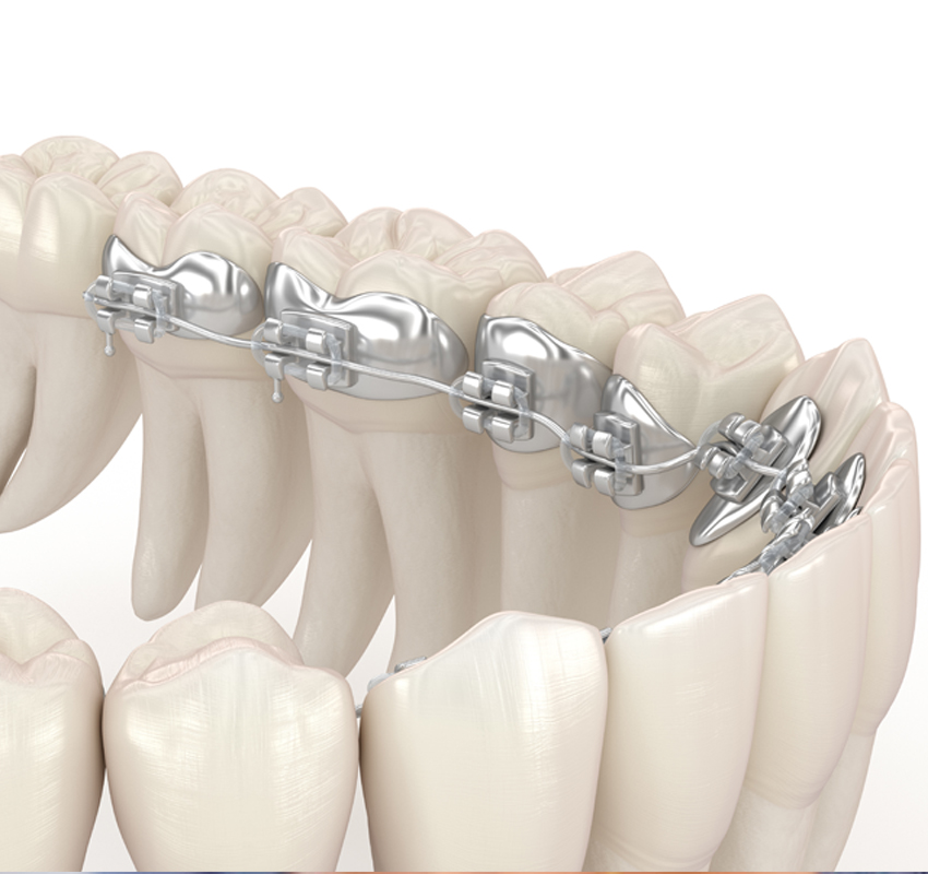 Orthodontie linguale adulte - orthodontie Lyon Croix-Rousse