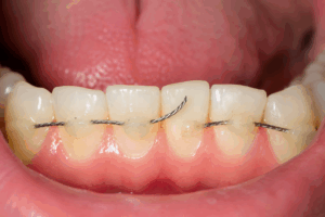 Fil de contention cassé derrière les dents nécessitant un contrôle orthodontique
