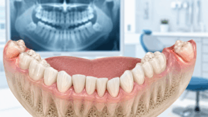 Dents de sagesse et chevauchement des incisives inférieures en orthodontie
